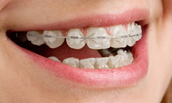 Clear Braces - Brazeau Orthodontics